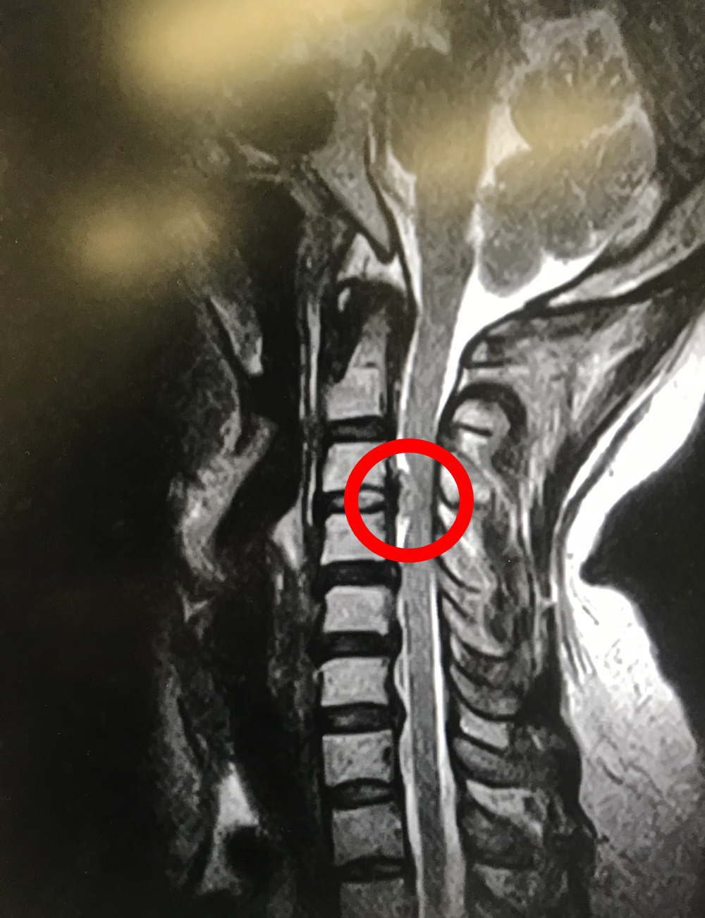 頚椎ヘルニア MRI画像