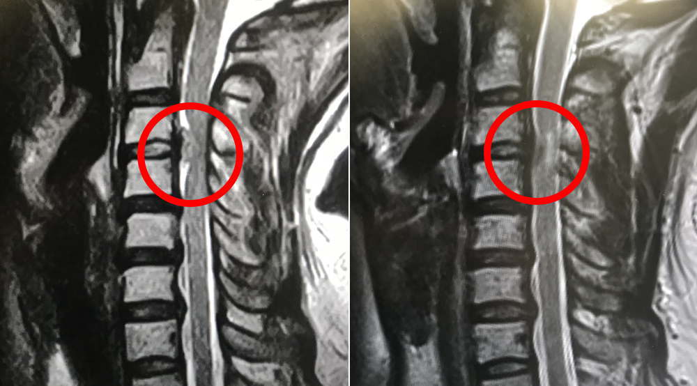 頸椎ヘルニア ビフォーアフター MRI画像